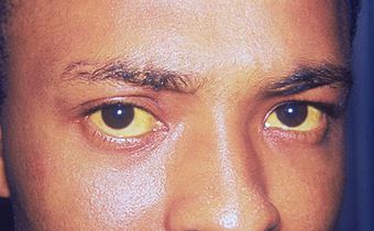 Hépatite A, B, C, D, E : Comment reconnaitre ces maladies destructrices mais silencieuses ? (Yeux jaunis, l'un des symptômes de l'hépatite A.)/Centers for Disease Control and Prevention
