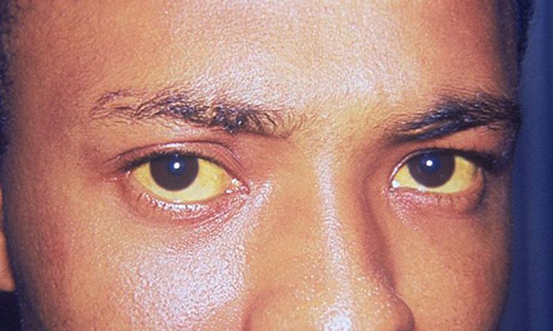 Hépatite A, B, C, D, E : Comment reconnaitre ces maladies destructrices mais silencieuses ? (Yeux jaunis, l'un des symptômes de l'hépatite A.)/Centers for Disease Control and Prevention