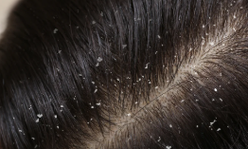 Dandruff