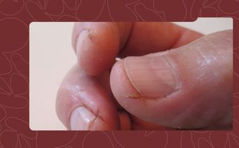 Dry Hands and Cuticles? Here’s How to Heal and Prevent Them