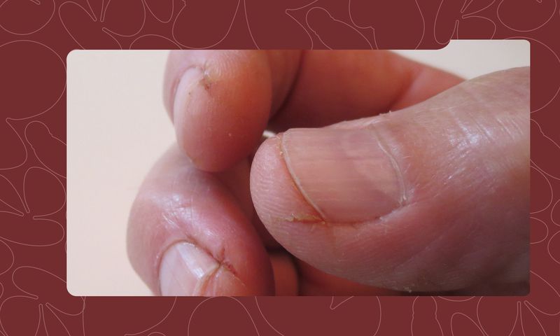 How to Treat and Prevent Dry Hands and Cuticles