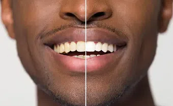 Foods that can naturally whiten your teeth [DentistEastWenatchee]