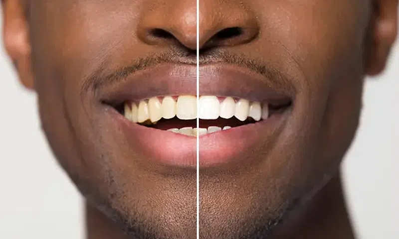 Foods that can naturally whiten your teeth [DentistEastWenatchee]