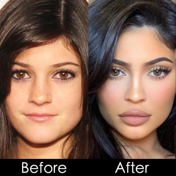 Kylie Jenner before and after [Pinterest]