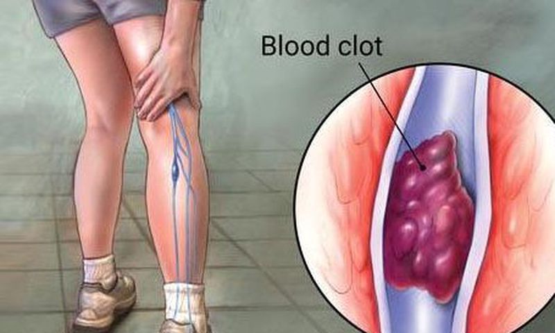 Deep vein thrombosis (DVT)