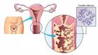 5 signes majeurs qui montrent que vous avez une infection vaginale