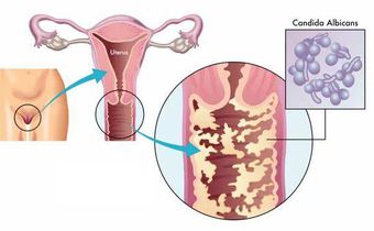 5 signes majeurs qui montrent que vous avez une infection vaginale