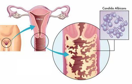 5 signes majeurs qui montrent que vous avez une infection vaginale