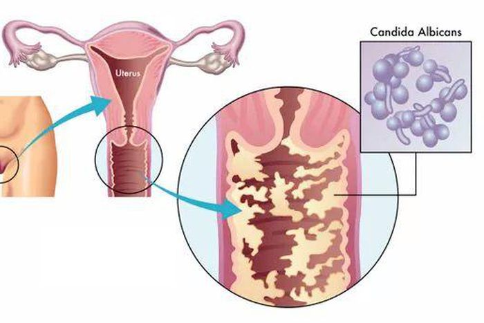 5 signes majeurs qui montrent que vous avez une infection vaginale