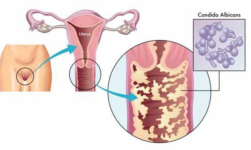 5 signes majeurs qui montrent que vous avez une infection vaginale