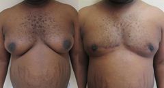 gynecomastie-avant-apres-1