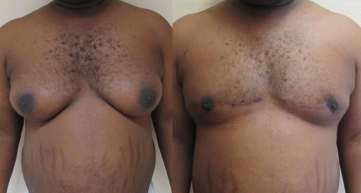 gynecomastie-avant-apres-1