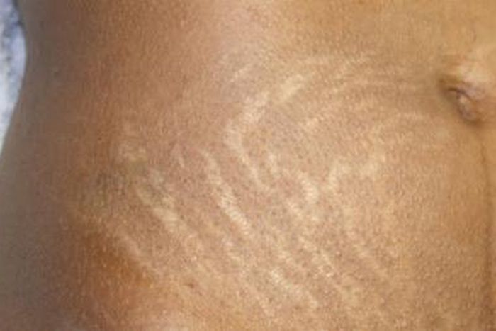 5 remèdes maison pour traiter les vergetures