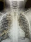 Radio de l'enfant : la trachée est bouchée par un os
