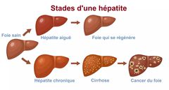 Hépatite A, B, C, D, E : Comment reconnaitre ces maladies destructrices mais silencieuses ?