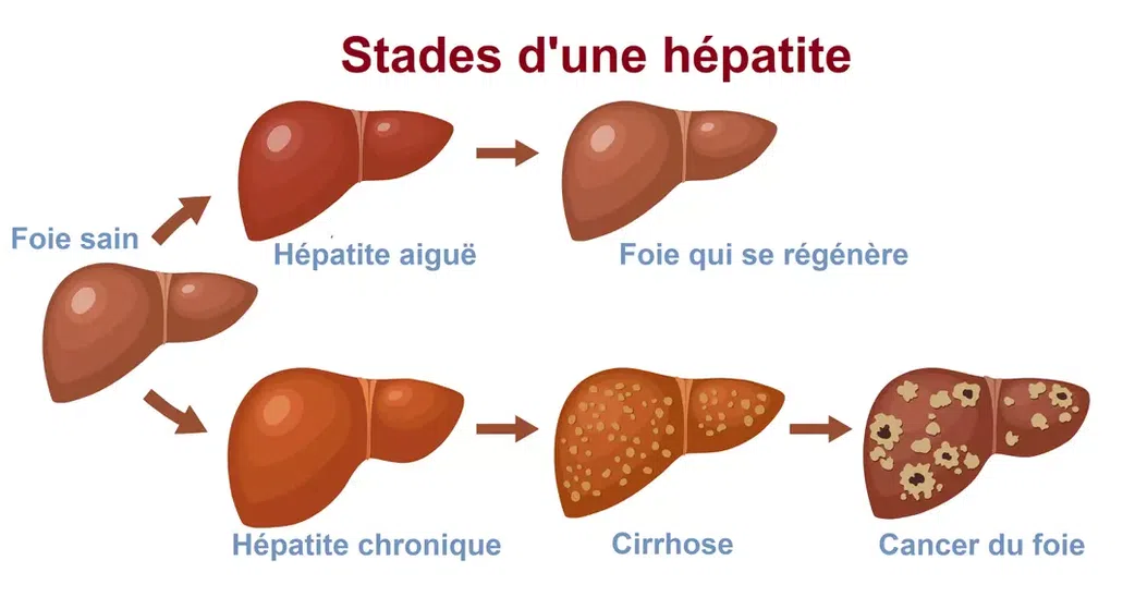 Hépatite A, B, C, D, E : Comment reconnaitre ces maladies destructrices mais silencieuses ?