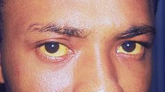 Hépatite A, B, C, D, E : Comment reconnaitre ces maladies destructrices mais silencieuses ? (Yeux jaunis, l'un des symptômes de l'hépatite A.)/Centers for Disease Control and Prevention