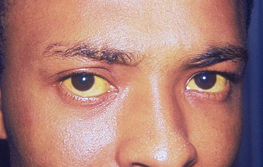 Hépatite A, B, C, D, E : Comment reconnaitre ces maladies destructrices mais silencieuses ? (Yeux jaunis, l'un des symptômes de l'hépatite A.)/Centers for Disease Control and Prevention