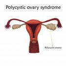 Le Syndrome des Ovaires Polykystiques (SOPK) : une maladie qui touche de nombreuses femmes