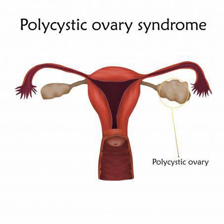 Le Syndrome des Ovaires Polykystiques (SOPK) : une maladie qui touche de nombreuses femmes