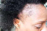 LE STRESS FAIT CHUTER VOS CHEVEUX : VOICI POURQUOI VOUS DEVEZ RÉAGIR