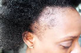 LE STRESS FAIT CHUTER VOS CHEVEUX : VOICI POURQUOI VOUS DEVEZ RÉAGIR