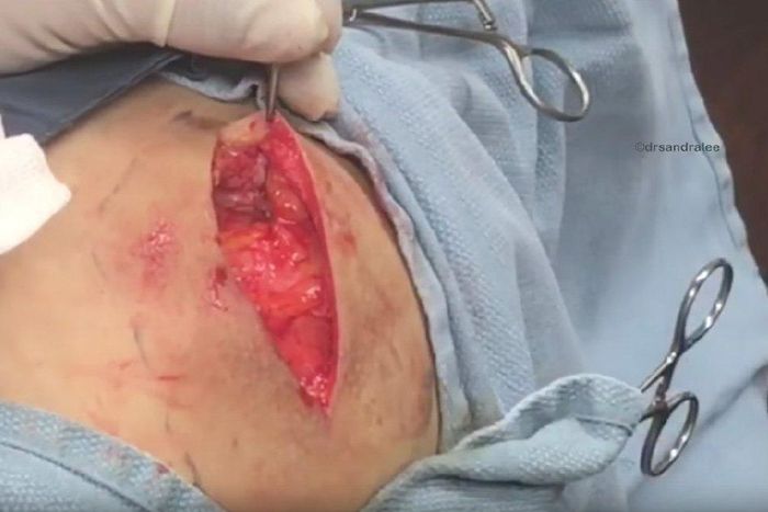 ___6978269___https:______static.pulse.com.gh___webservice___escenic___binary___6978269___2017___7___11___21___50-year-old-cyst-being-popped-1