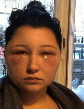 Woman’s head doubles in size after using hair dye