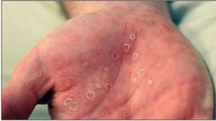6 common sexually transmitted diseases in Nigeria