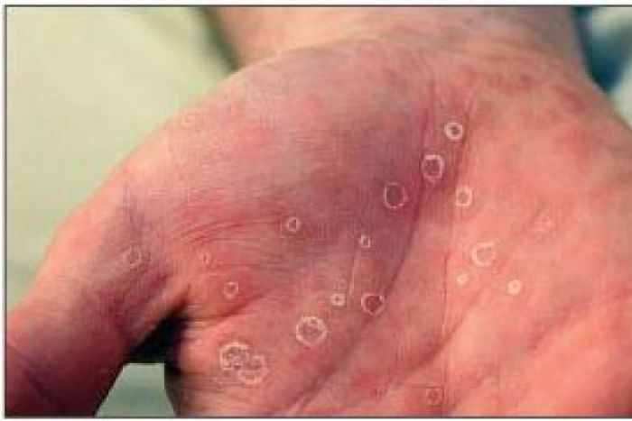 6 common sexually transmitted diseases in Nigeria