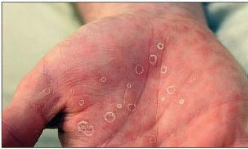 6 common sexually transmitted diseases in Nigeria