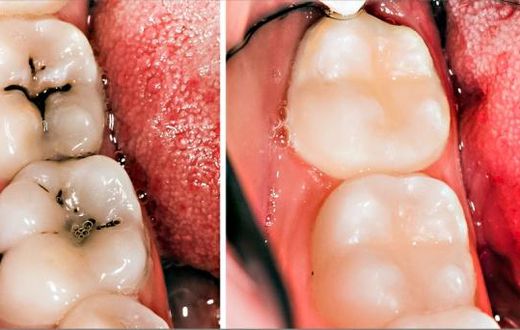 3 home remedies for tooth decay and cavities