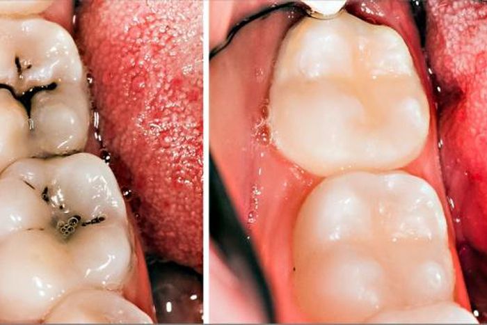 3 home remedies for tooth decay and cavities