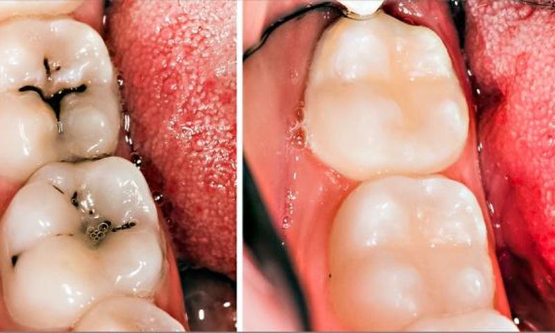 3 home remedies for tooth decay and cavities