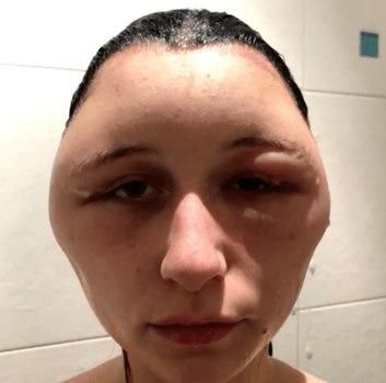 Woman’s head doubles in size after using hair dye