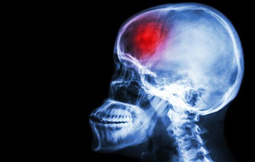___6536798___https:______static.pulse.com.gh___webservice___escenic___binary___6536798___2017___4___16___11___young-men-at-risk-for-stroke