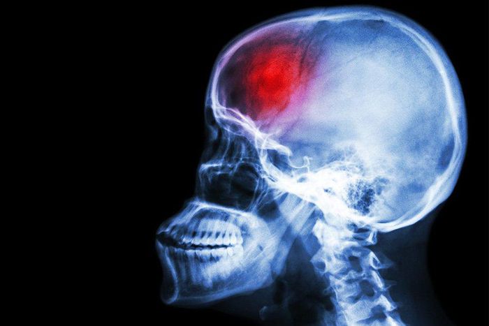 ___6536798___https:______static.pulse.com.gh___webservice___escenic___binary___6536798___2017___4___16___11___young-men-at-risk-for-stroke