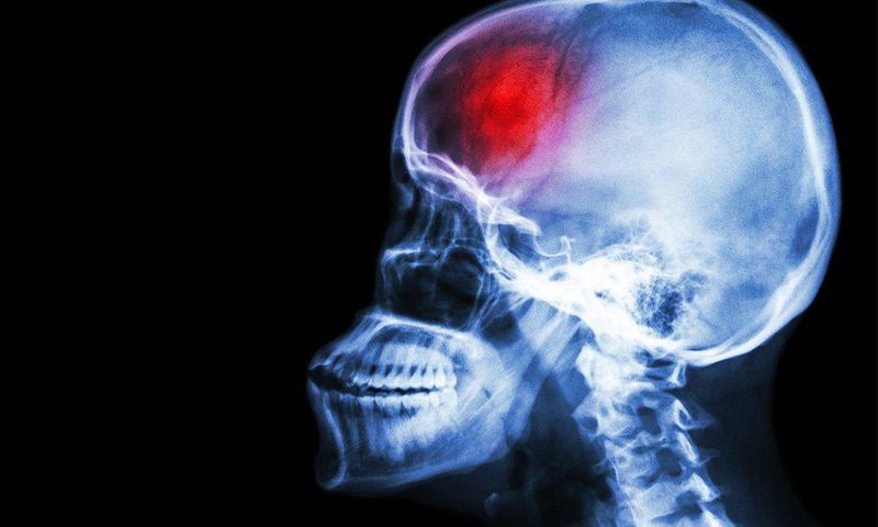 ___6536798___https:______static.pulse.com.gh___webservice___escenic___binary___6536798___2017___4___16___11___young-men-at-risk-for-stroke