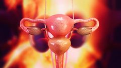 Are your periods irregular? You could have this syndrome and not even know it