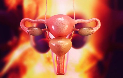 Are your periods irregular? You could have this syndrome and not even know it