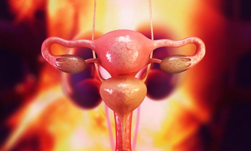 Are your periods irregular? You could have this syndrome and not even know it