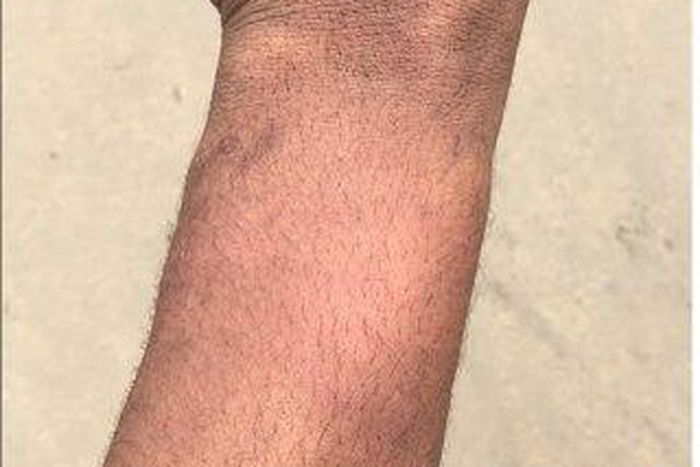 Bruises from the alleged police assault