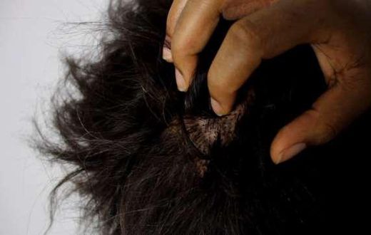 Dandruff/dry scalp is a common lifestyle isse