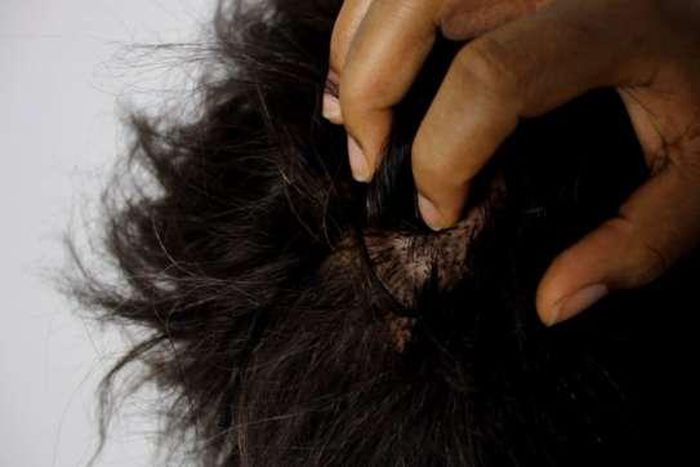 Dandruff/dry scalp is a common lifestyle isse