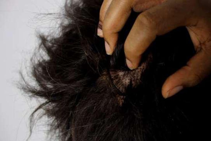 Dandruff/dry scalp is a common lifestyle isse