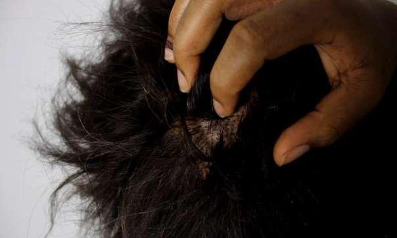 Dandruff/dry scalp is a common lifestyle isse