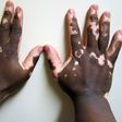 ___6719201___https:______static.pulse.com.gh___webservice___escenic___binary___6719201___2017___5___22___17___Vitiligo2