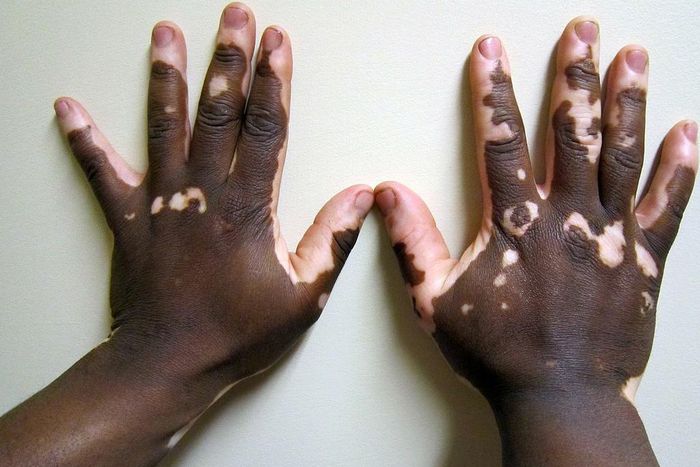 ___6719201___https:______static.pulse.com.gh___webservice___escenic___binary___6719201___2017___5___22___17___Vitiligo2