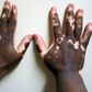 ___6719201___https:______static.pulse.com.gh___webservice___escenic___binary___6719201___2017___5___22___17___Vitiligo2