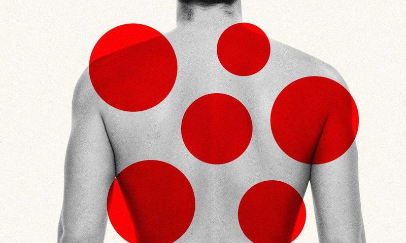 pay someone to pop pimples on your back